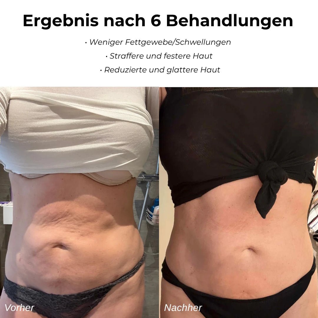 CelluGo™ – Anti - Cellulite Gerät für sichtbar glattere Haut - Varelax™