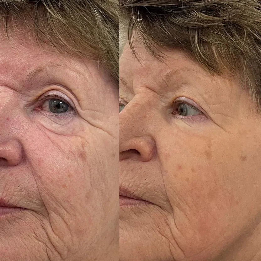 VareLift™ - Koreanisches Lifting-Serum mit Effekt ab der ersten Anwendung - Varelax™